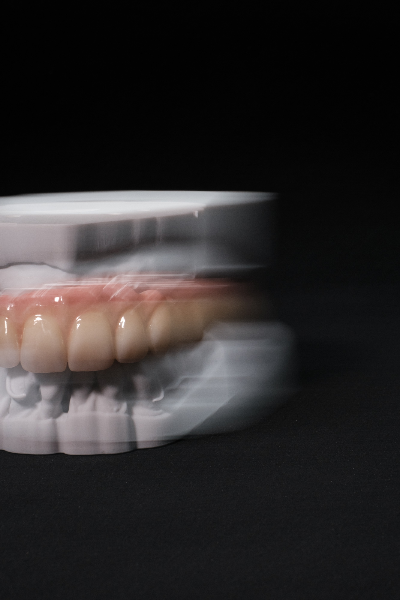 Vollzirkonarbeit auf Implantate okklusal verschraubt