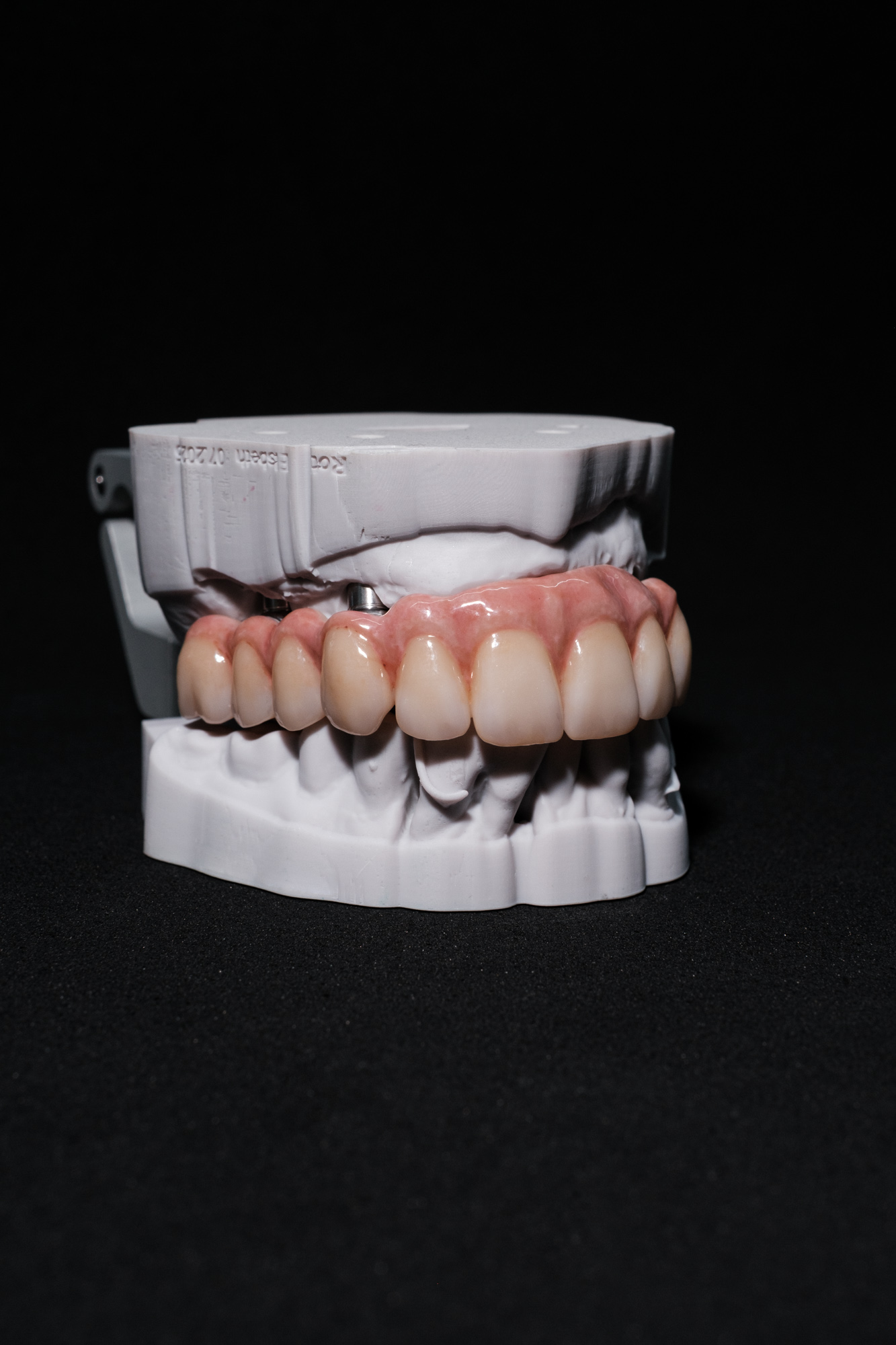 Vollzirkonarbeit auf Implantate okklusal verschraubt