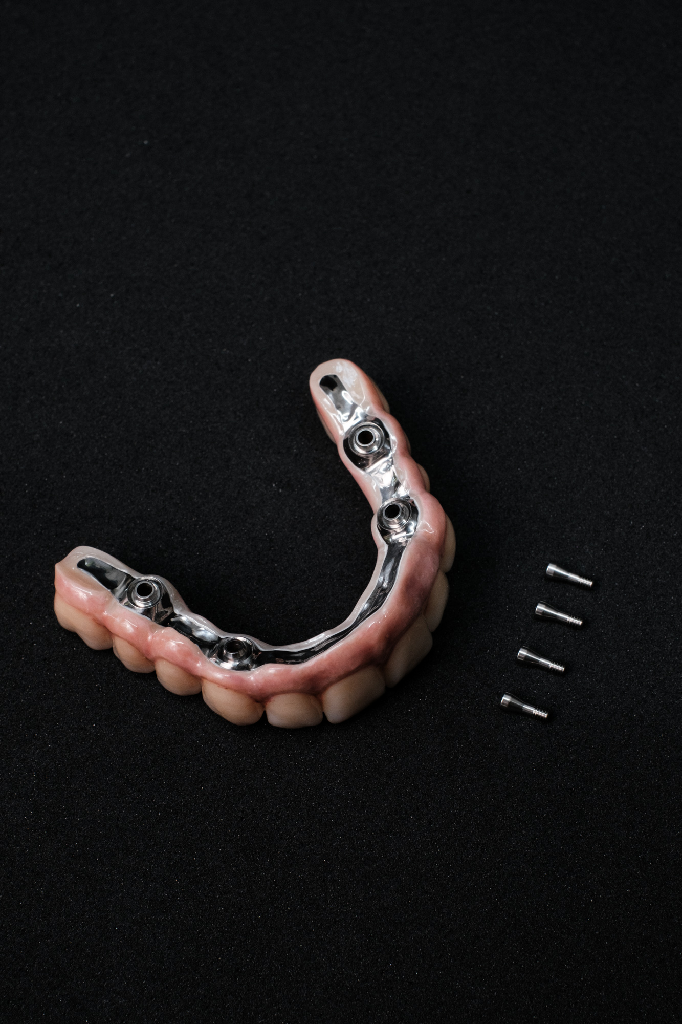 Vollzirkonarbeit auf Implantate okklusal verschraubt