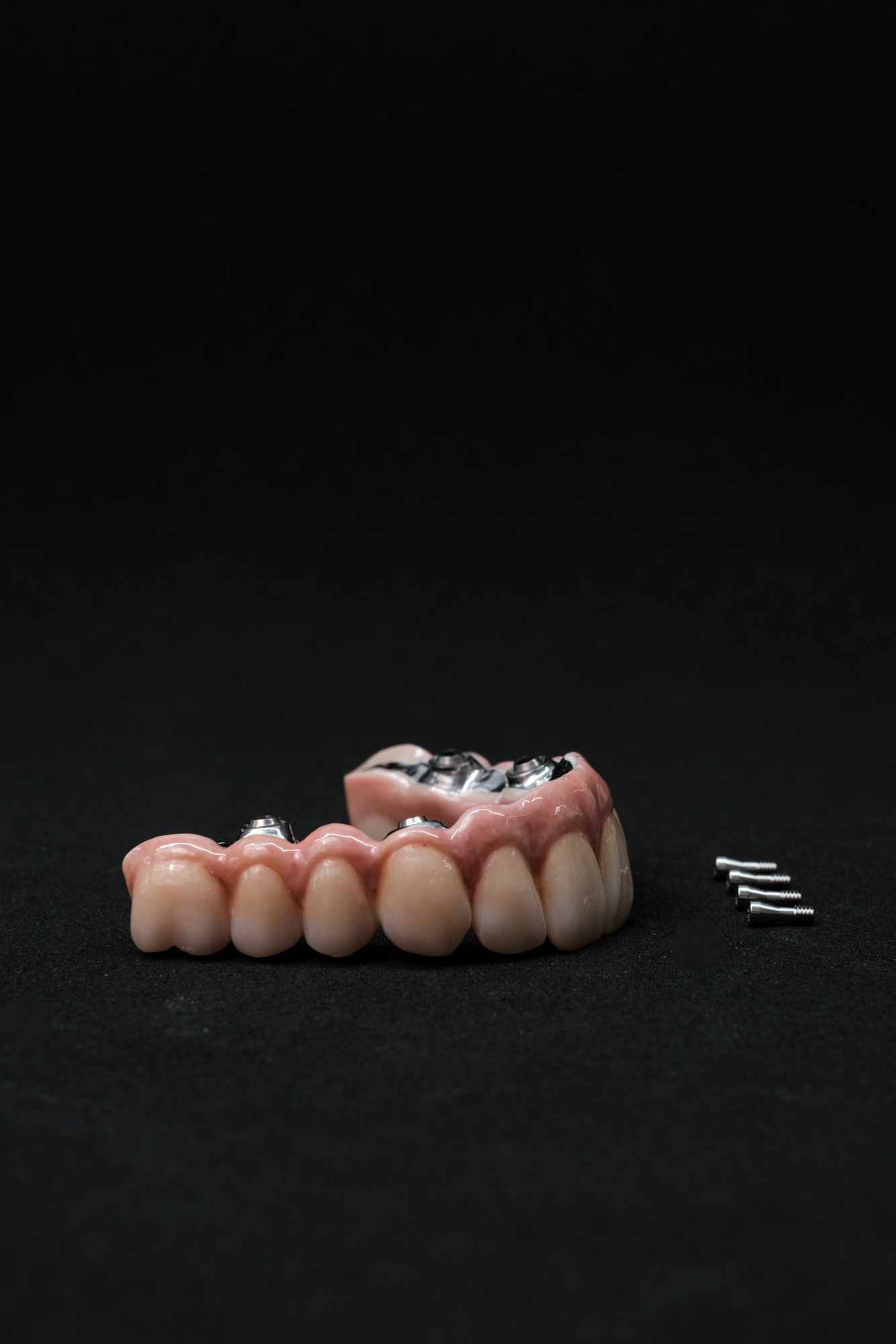 Vollzirkonarbeit auf Implantate okklusal verschraubt