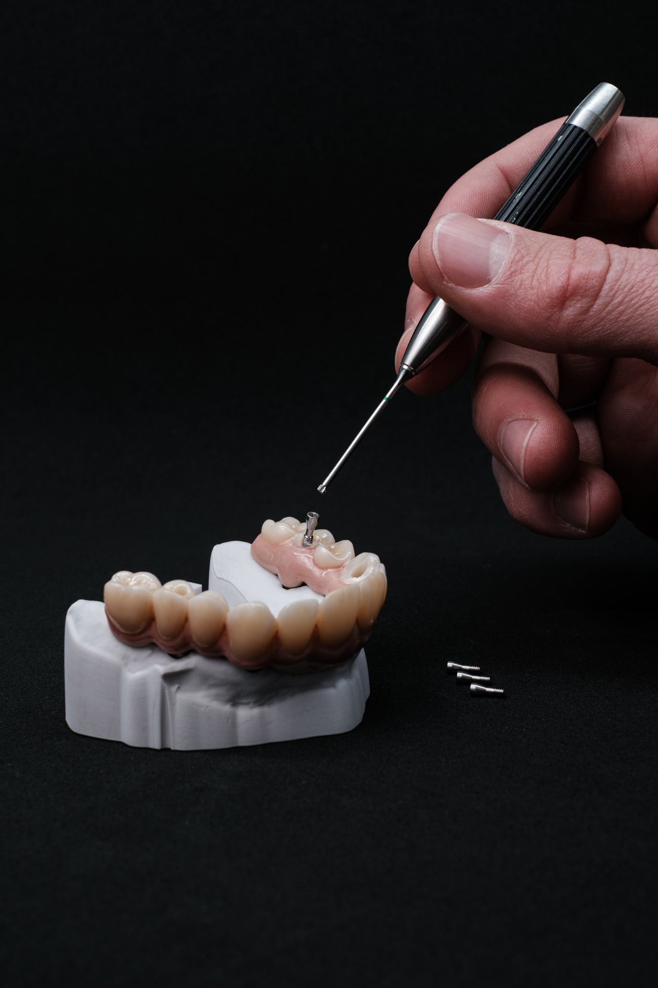 Vollzirkonarbeit auf Implantate okklusal verschraubt