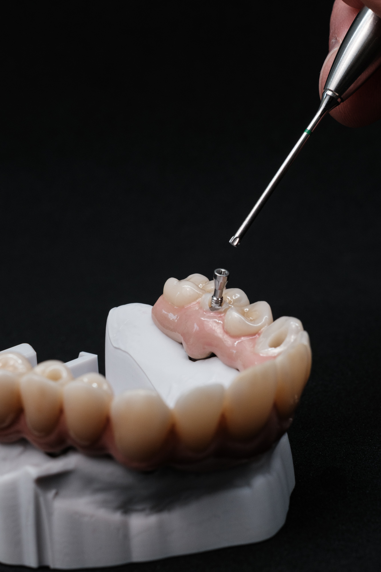 Vollzirkonarbeit auf Implantate okklusal verschraubt